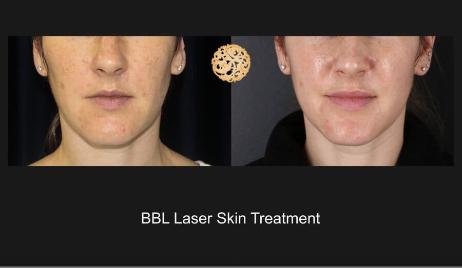 BBL Laser Before & After