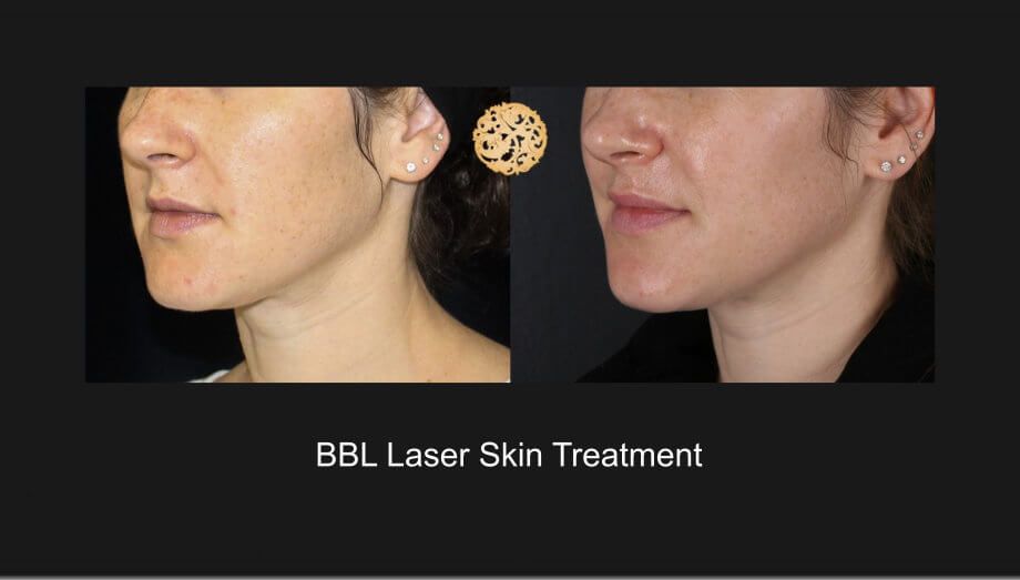 BBL Laser Before & After