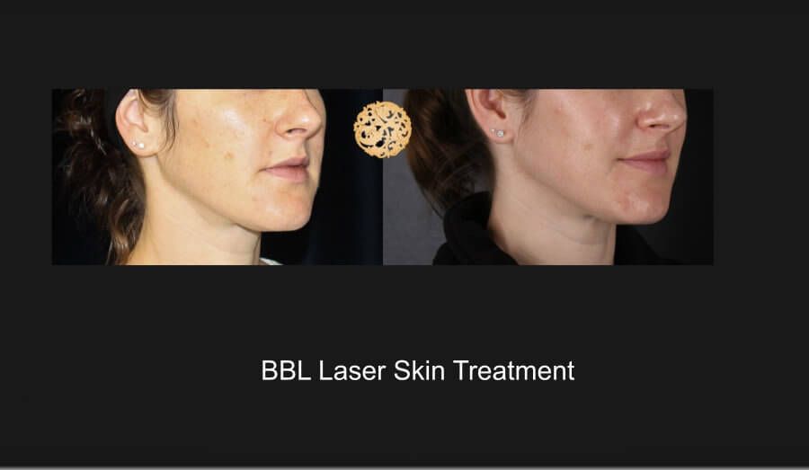 Bbl Laser Before & After