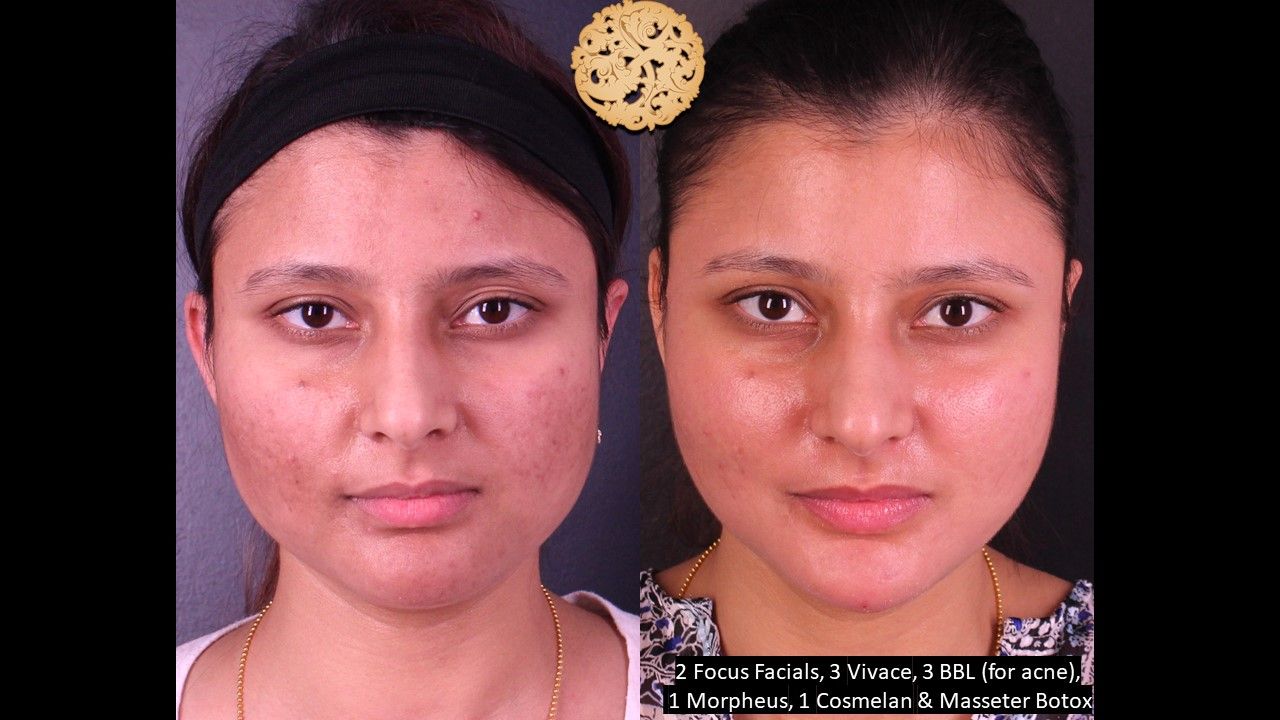 BBL Laser Before & After