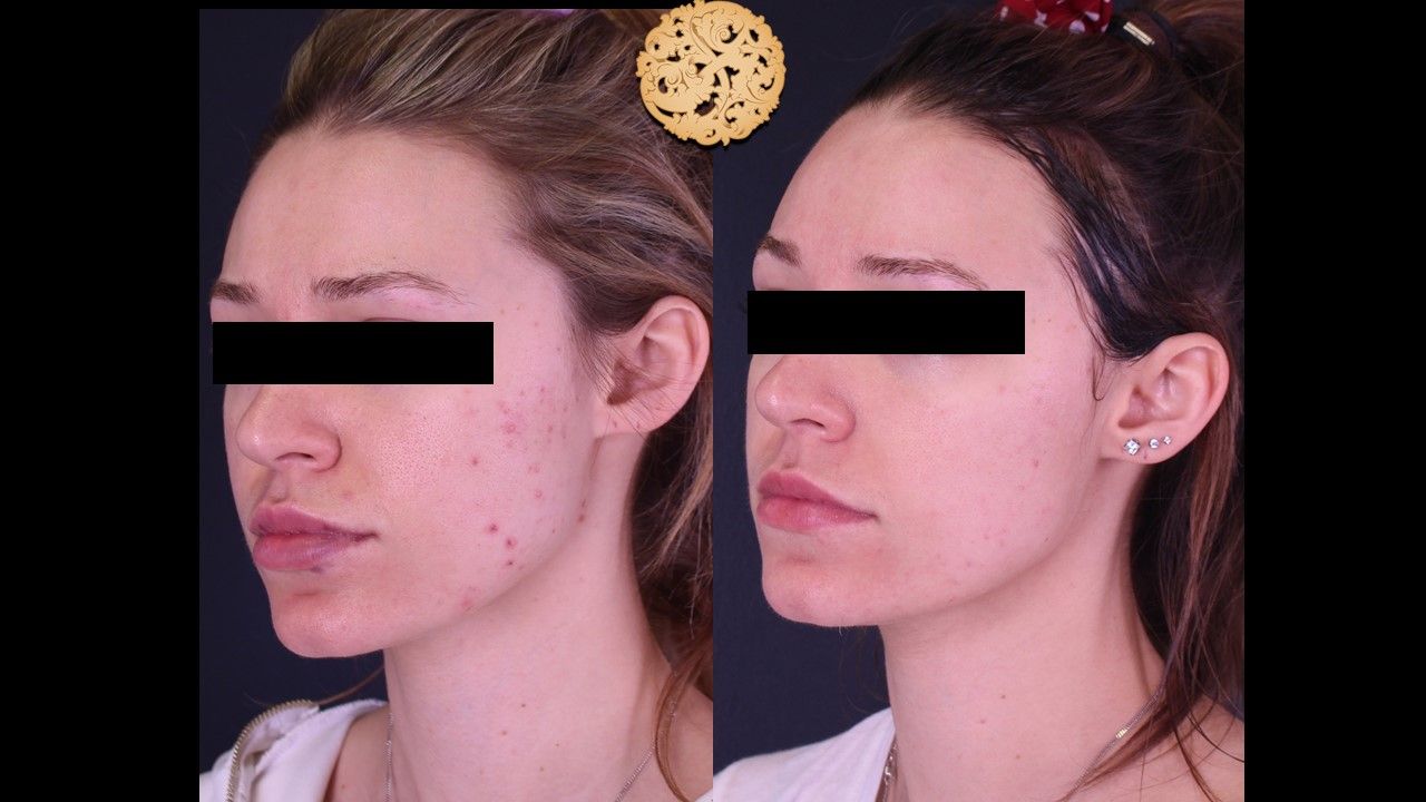 BBL Laser Before & After