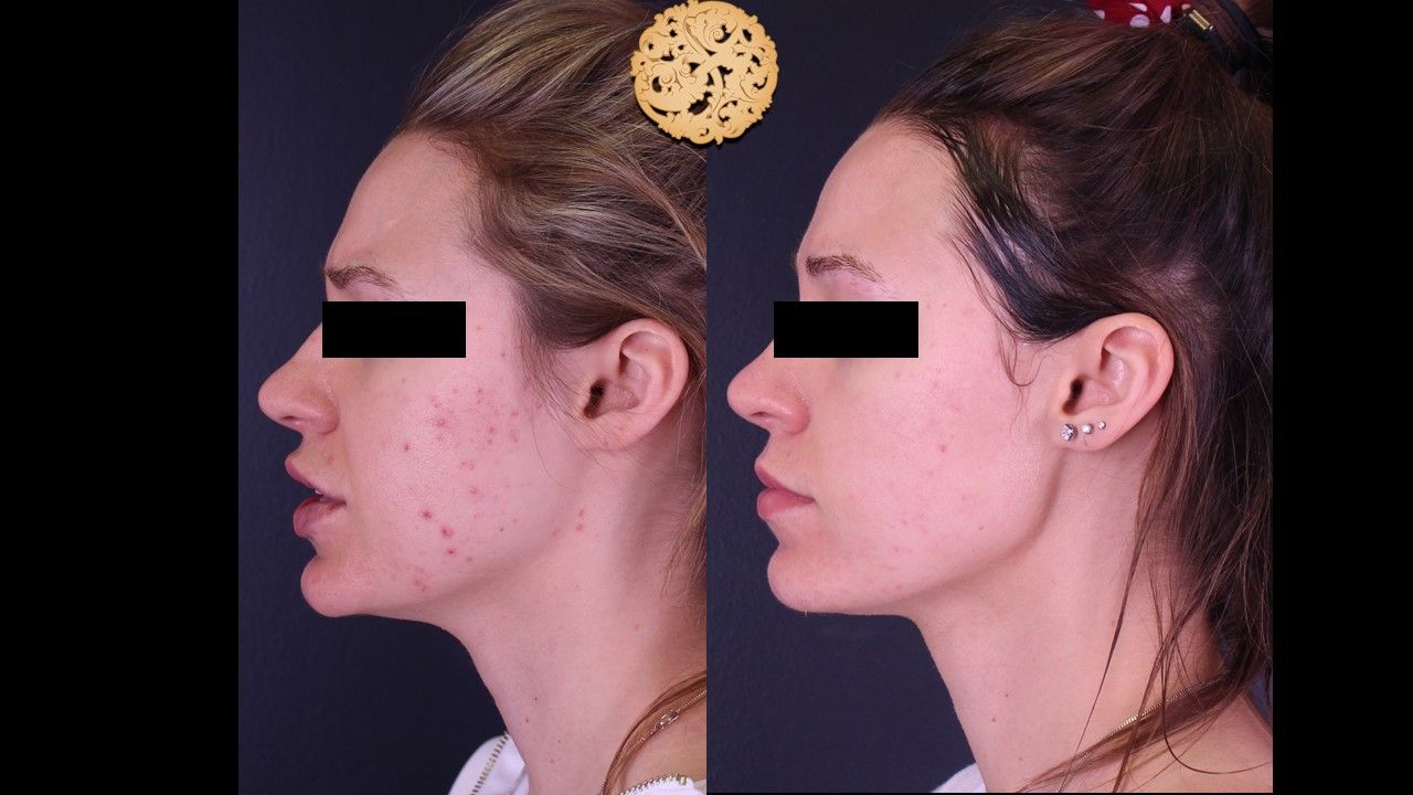 Bbl Laser Before & After