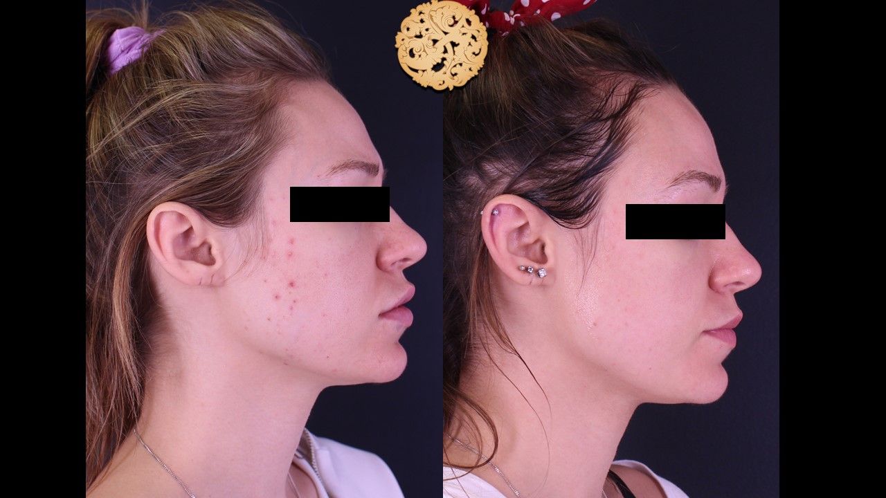 Bbl Laser Before & After