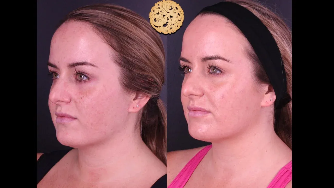 Bbl Laser Before & After