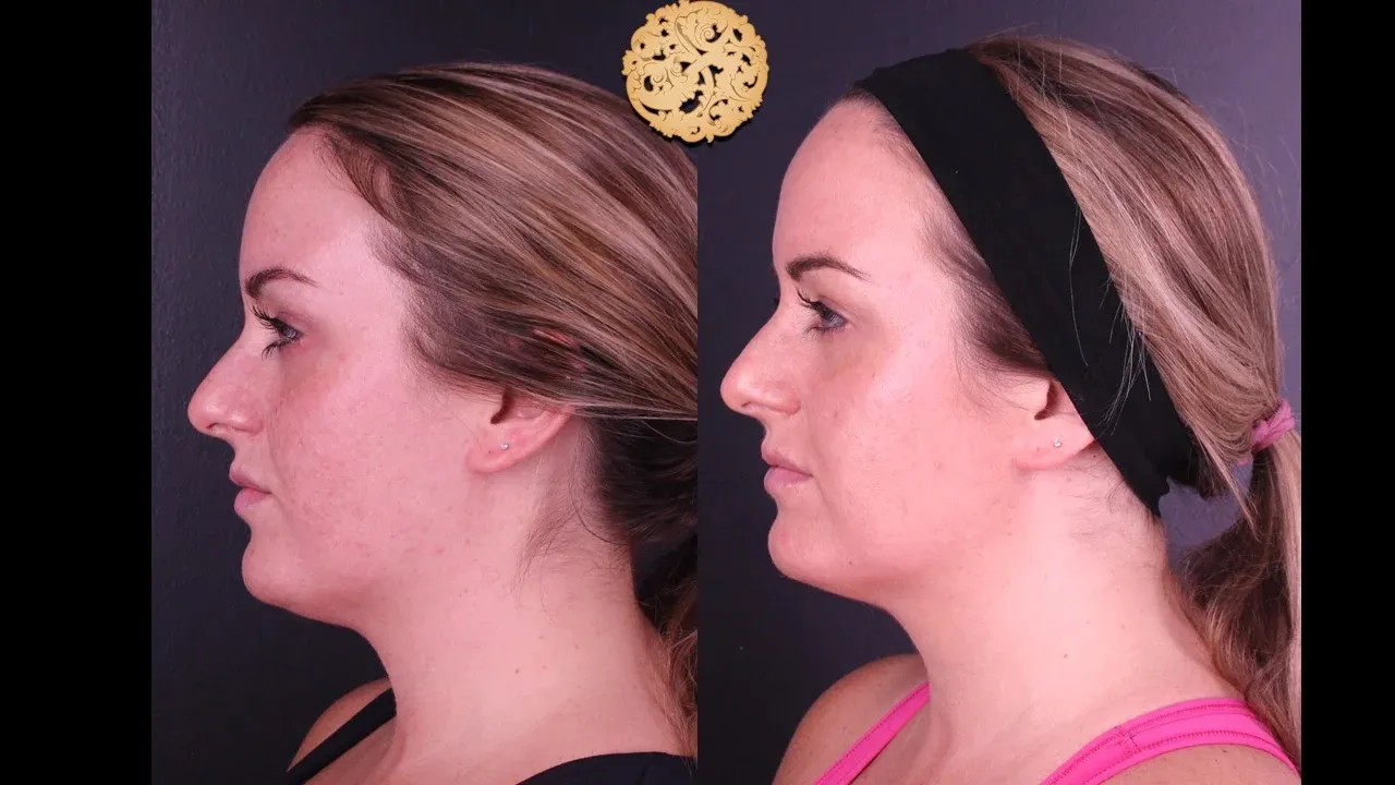 Bbl Laser Before & After