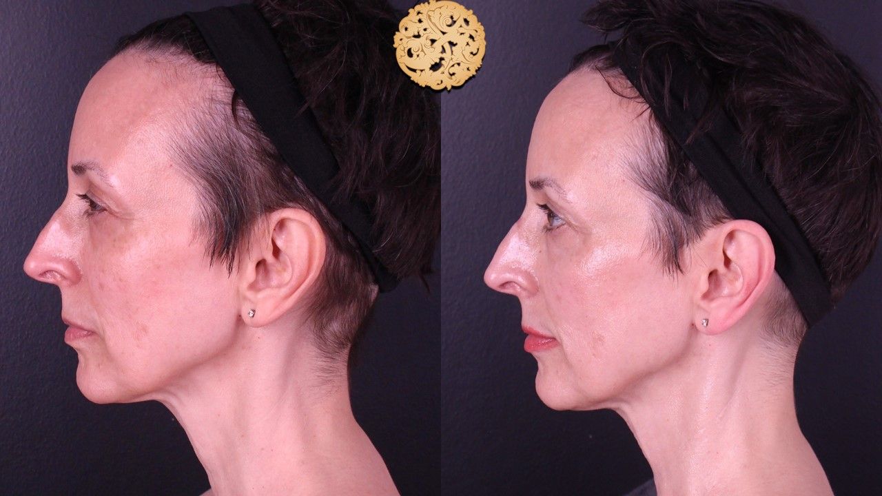 BBL Laser Before & After