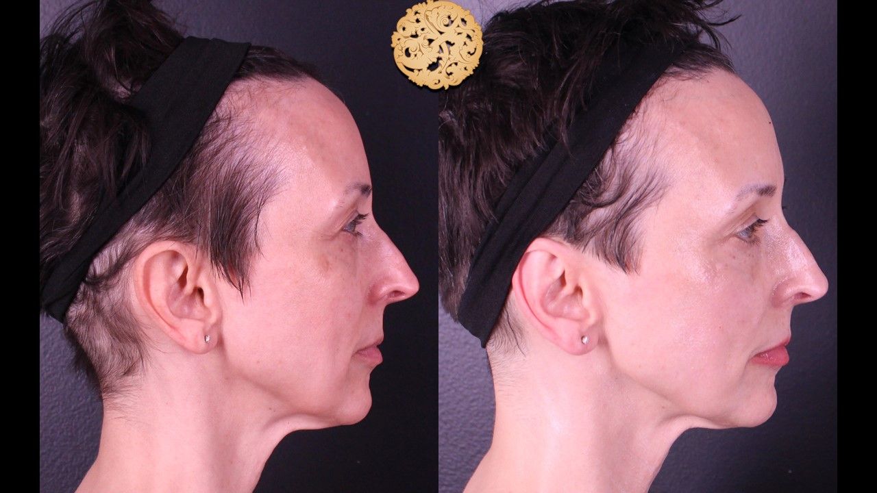 Bbl Laser Before & After