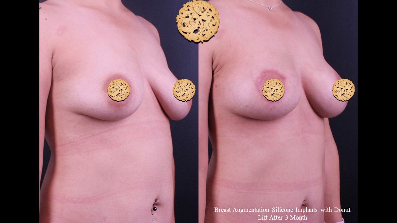 Breast Augmentation Before & After