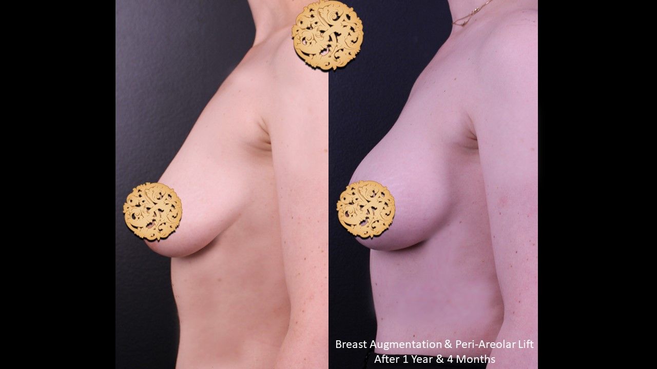 Breast Augmentation Before & After