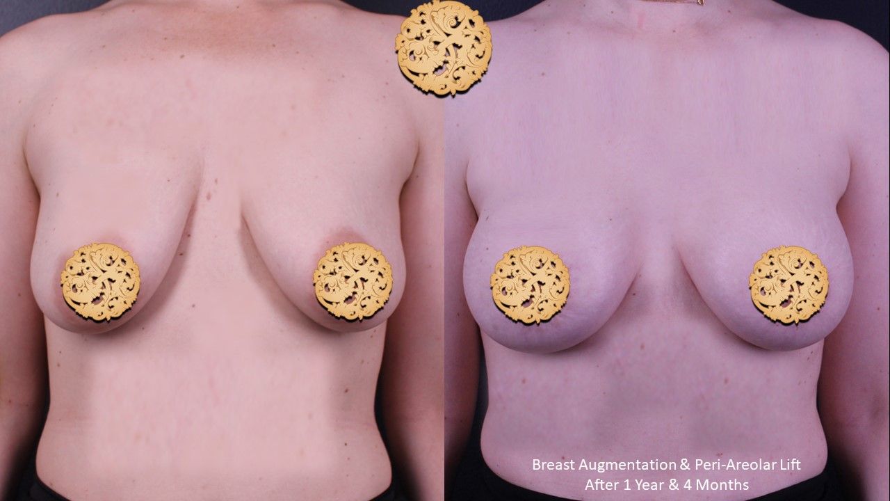 Breast Augmentation Before & After