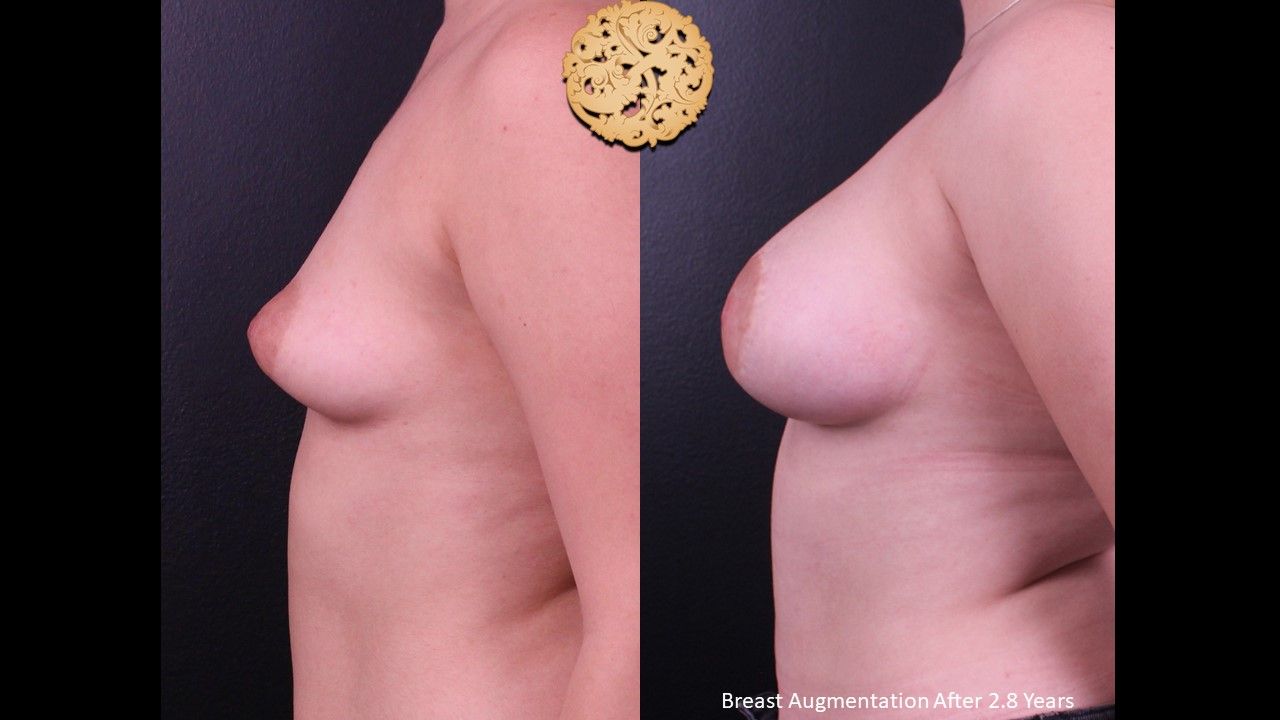 Breast Augmentation Before & After