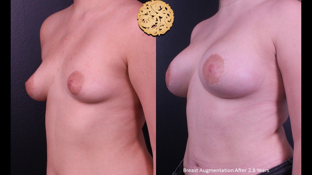 Breast Augmentation Before & After