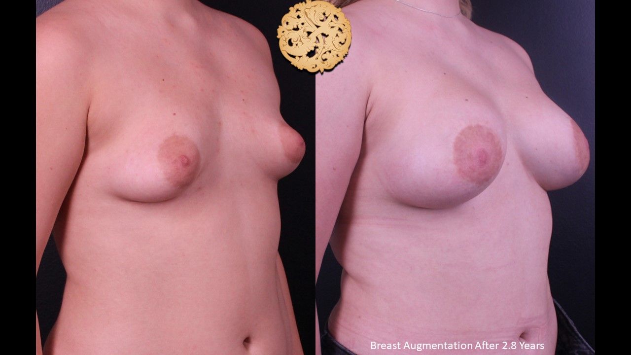 Breast Augmentation Before & After