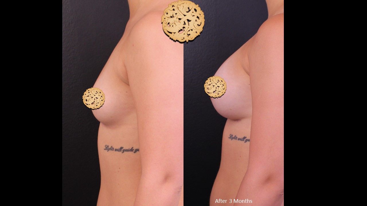 Breast Augmentation Before & After