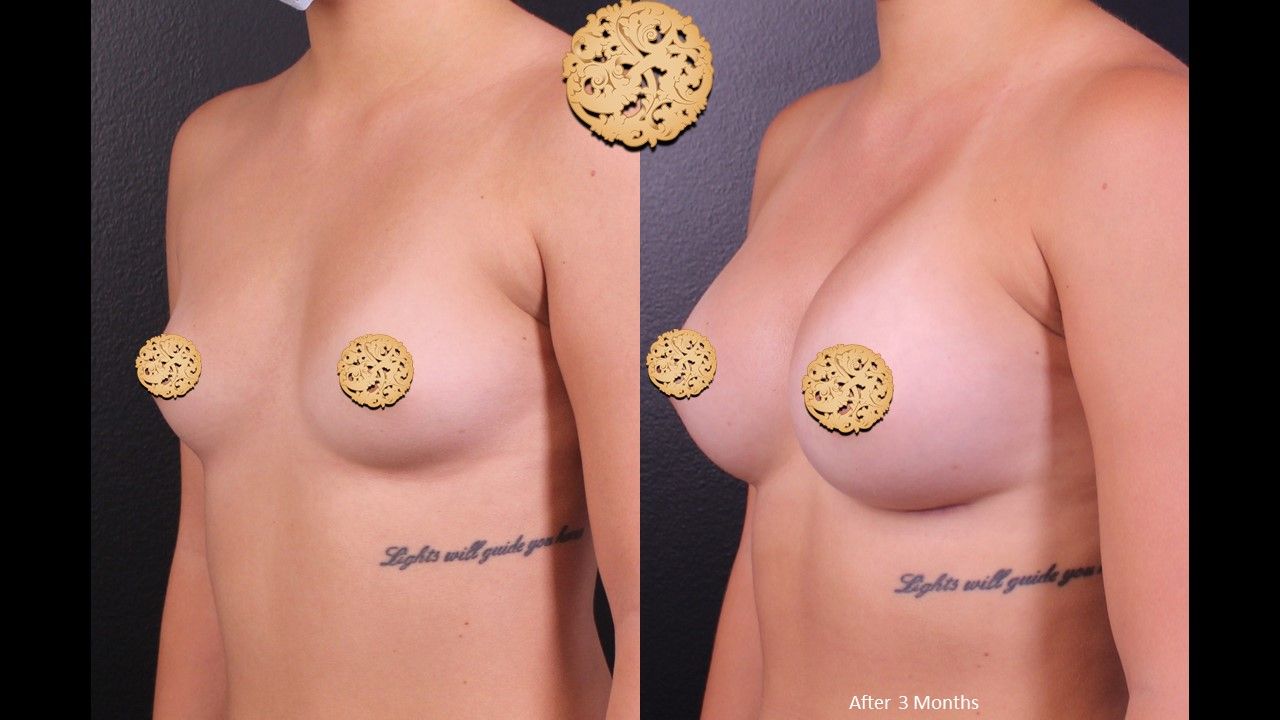 Breast Augmentation Before & After