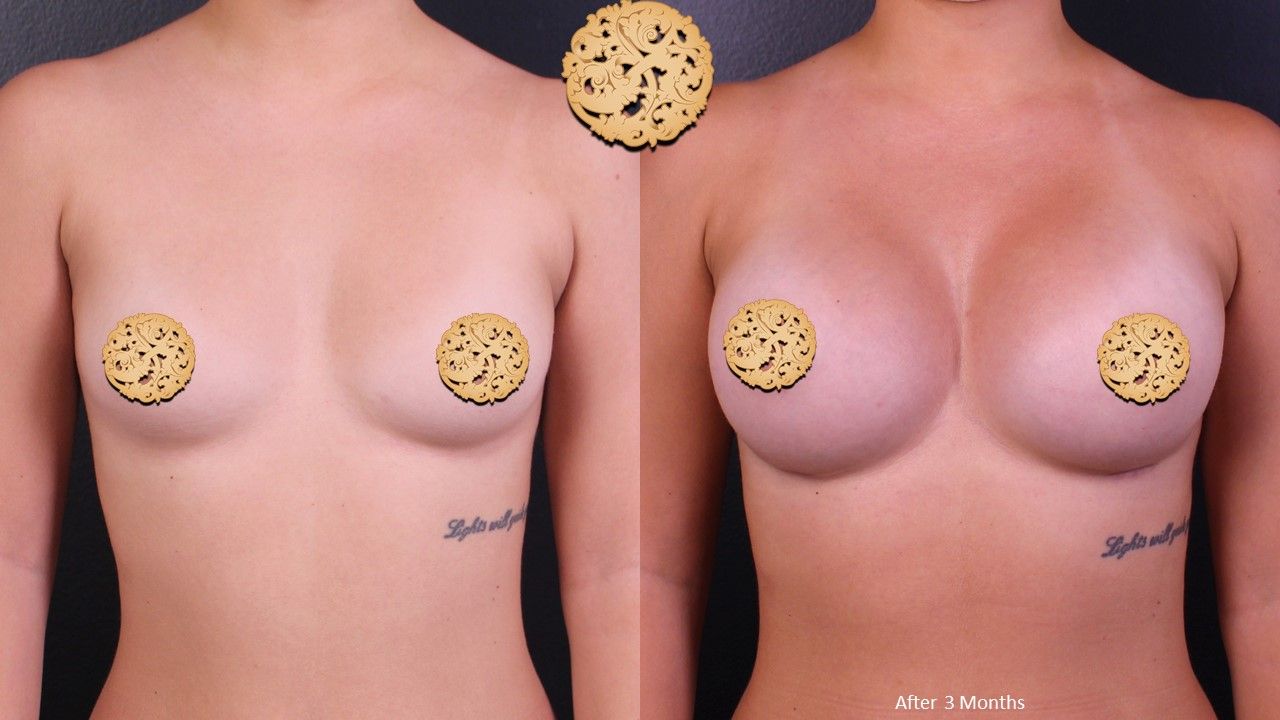 Breast Augmentation Before & After