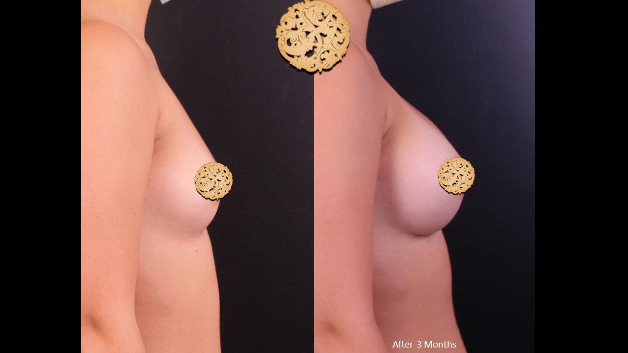 Breast Augmentation Before & After