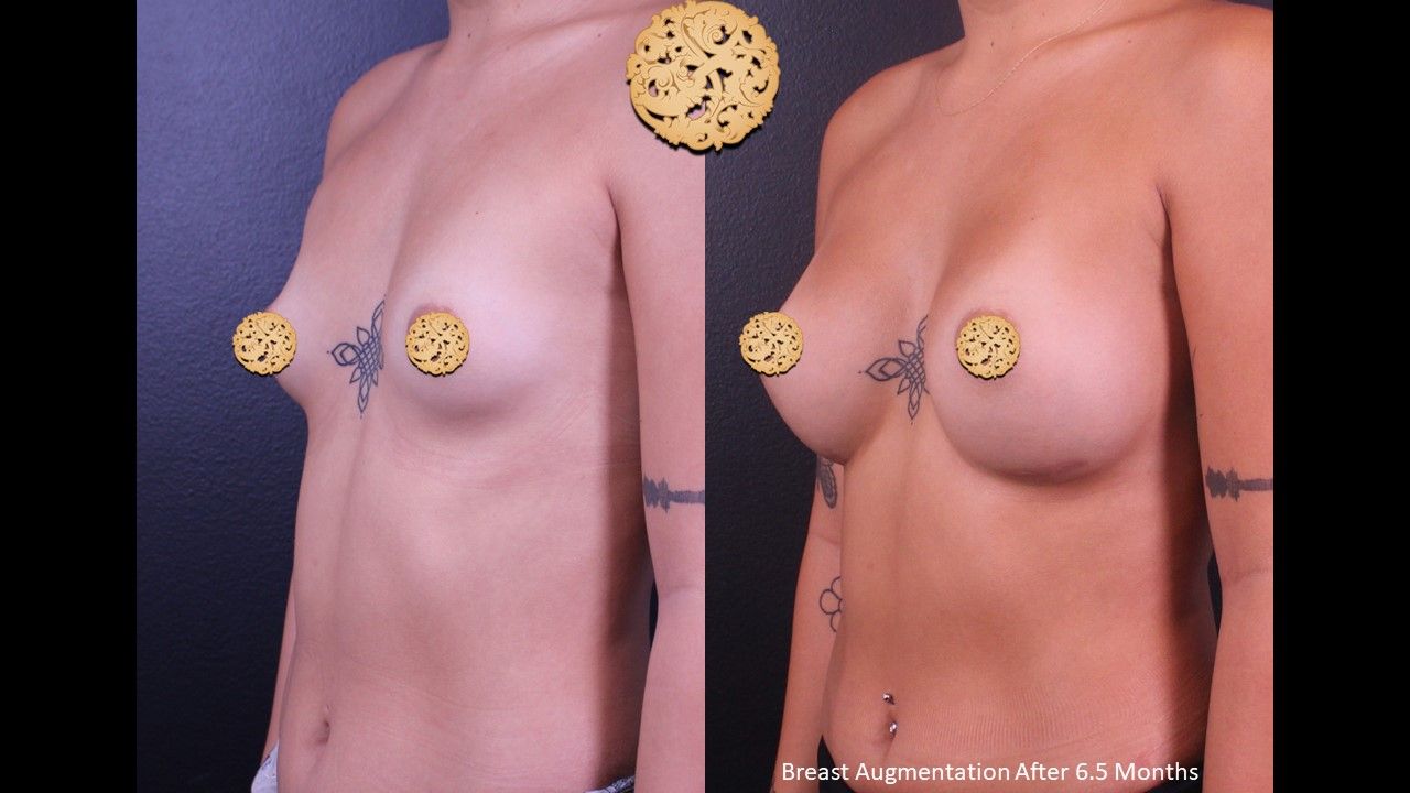 Breast Augmentation Before & After
