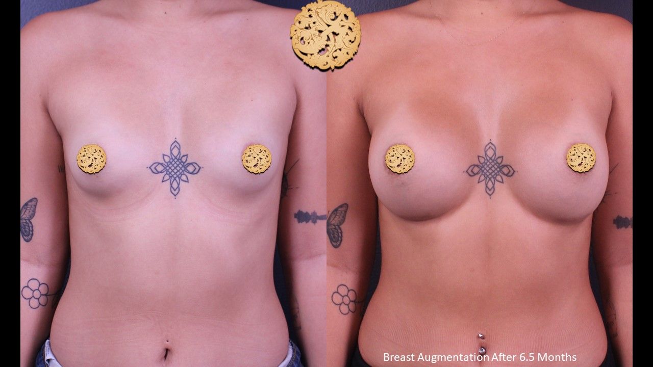 Breast Augmentation Before & After