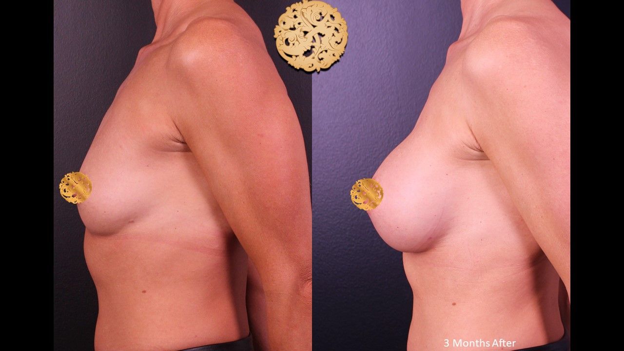 Breast Augmentation Before & After