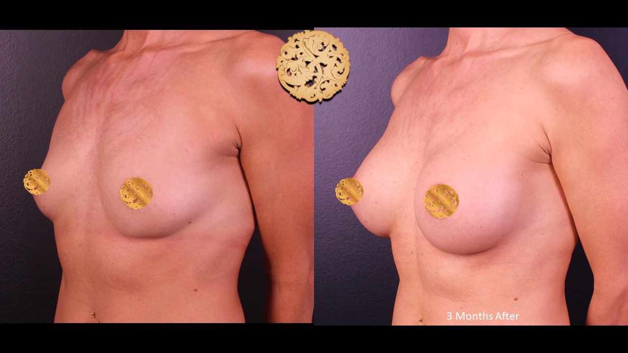 Breast Augmentation Before & After