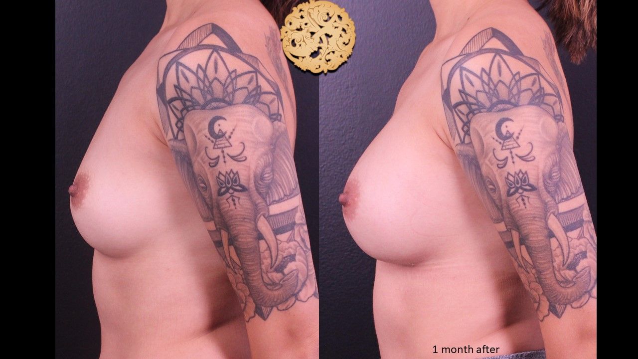 Breast Augmentation Before & After
