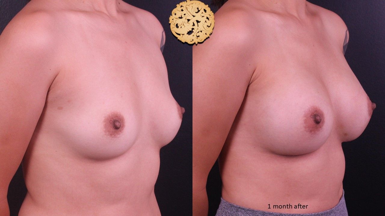 Breast Augmentation Before & After
