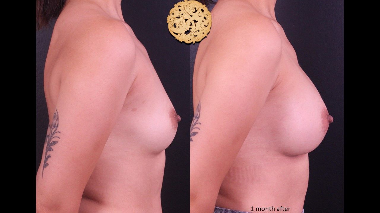 Breast Augmentation Before & After