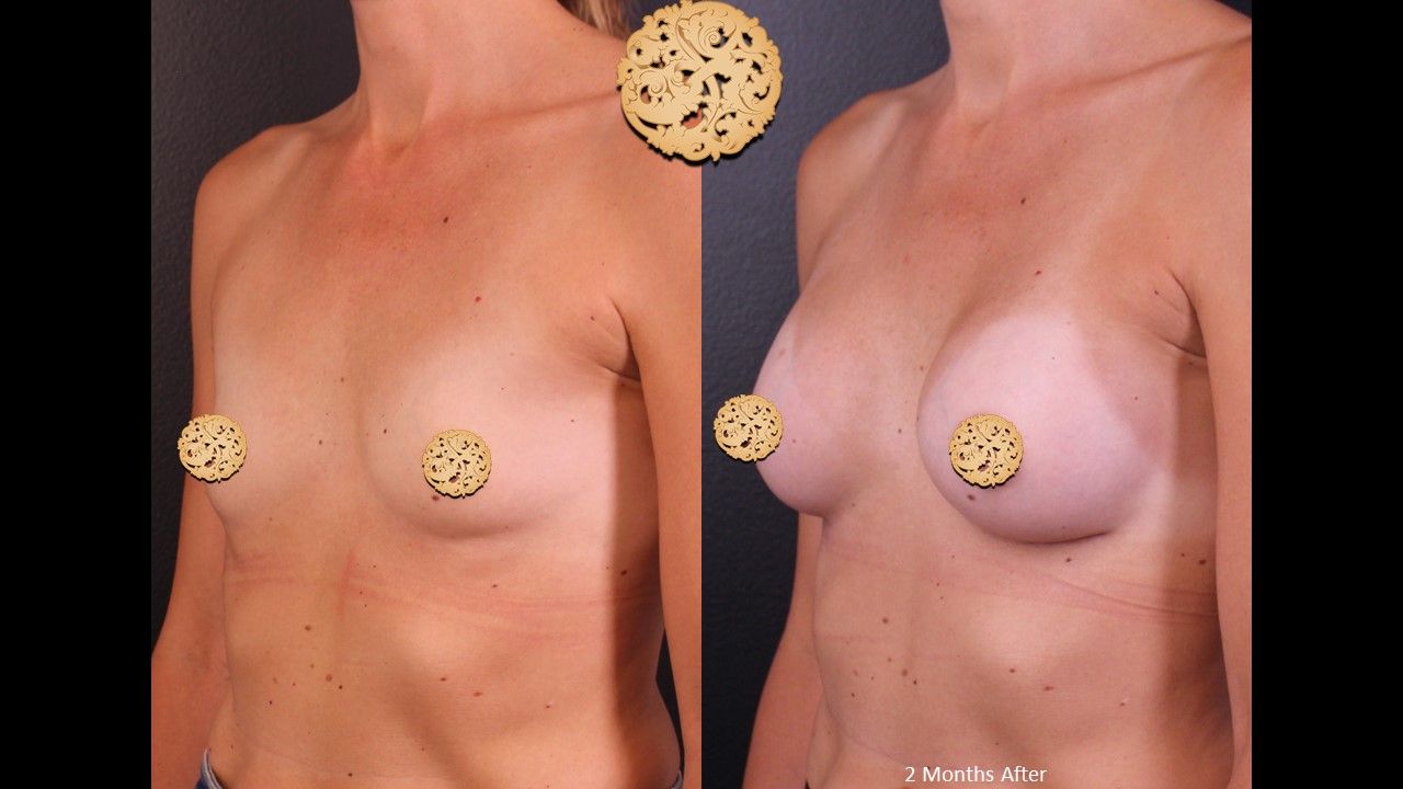 Breast Augmentation Before & After