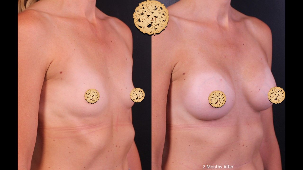 Breast Augmentation Before & After
