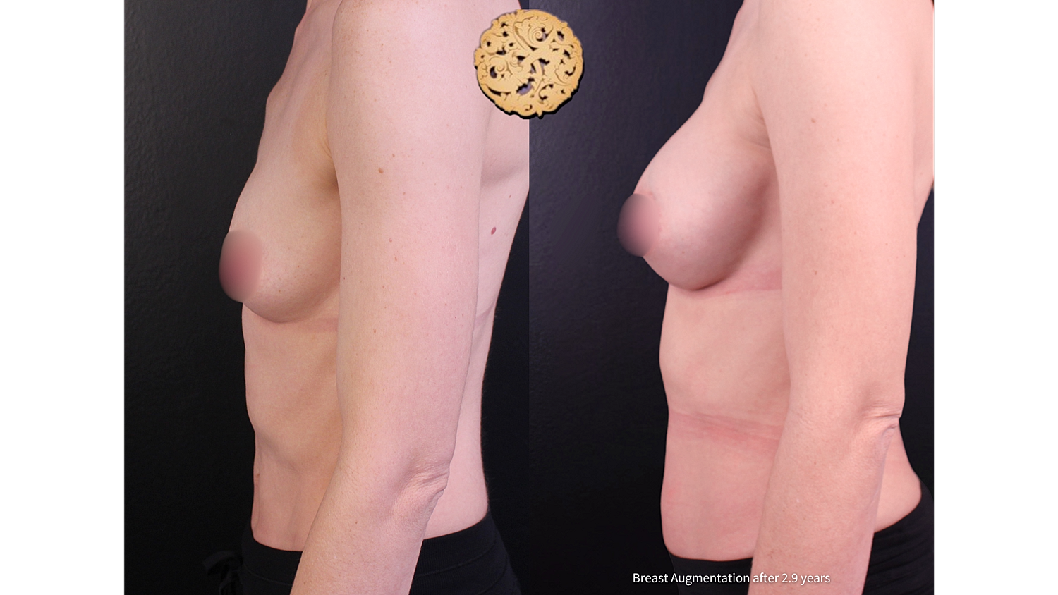 Breast augmentation results from different angles.