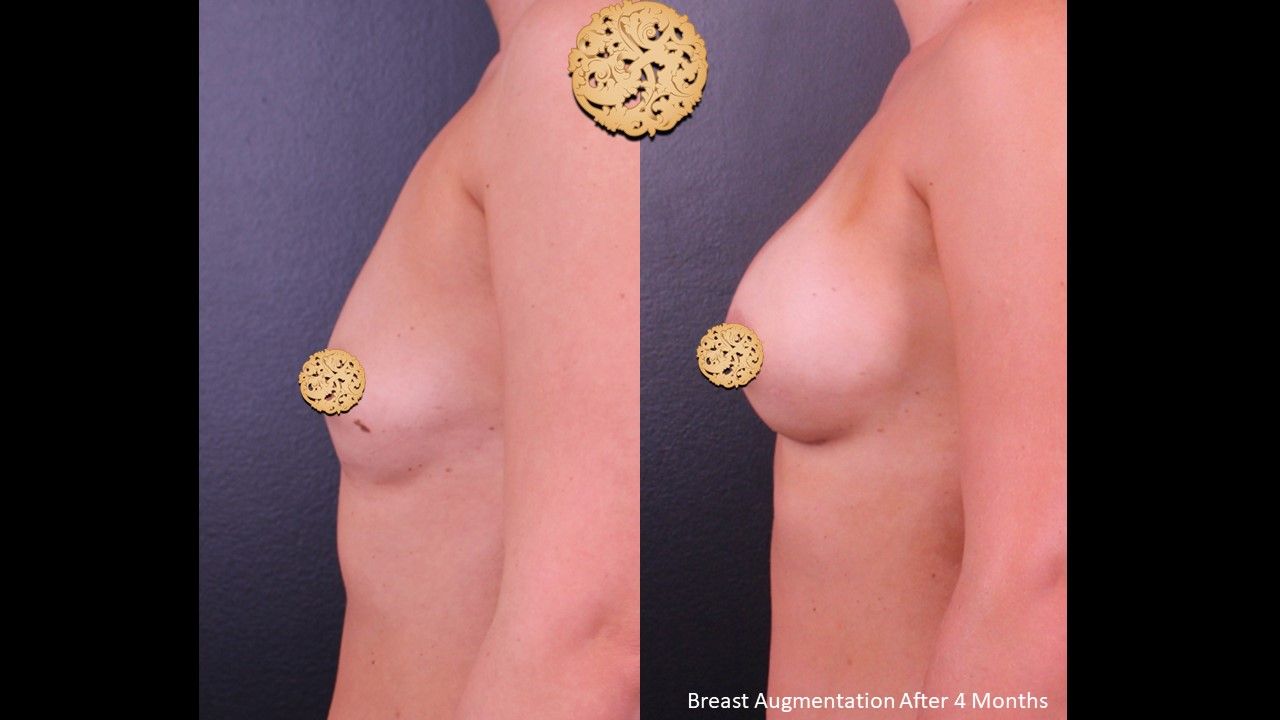 Breast Augmentation Before & After