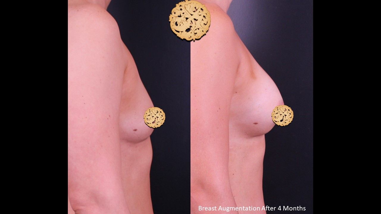 Breast Augmentation Before & After
