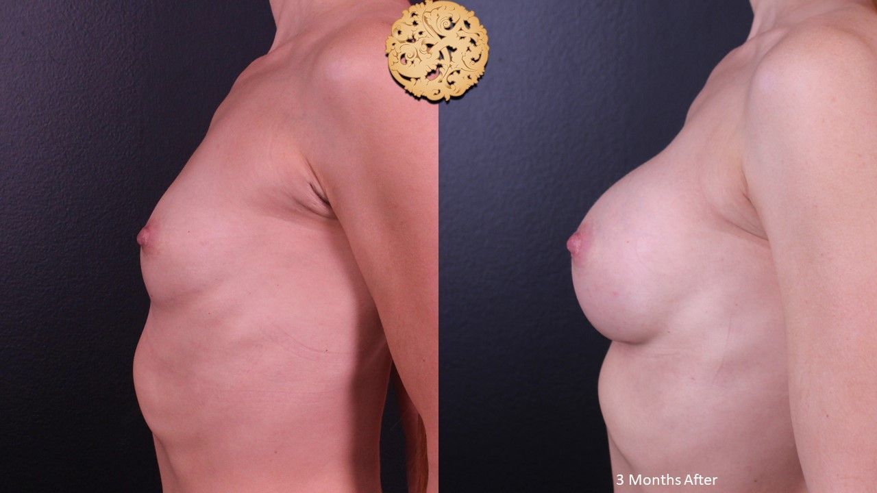 Breast Augmentation Before & After