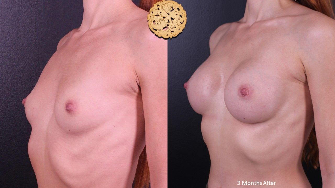 Breast Augmentation Before & After