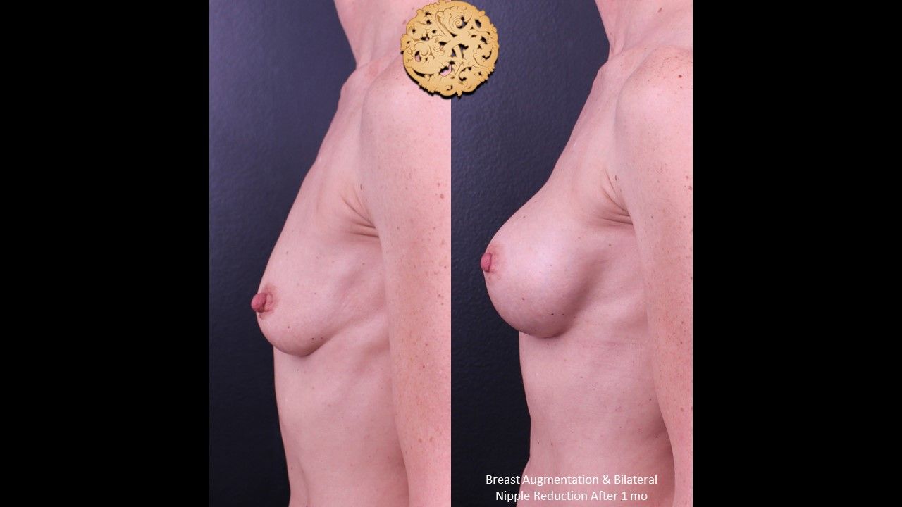 Breast Augmentation Before & After