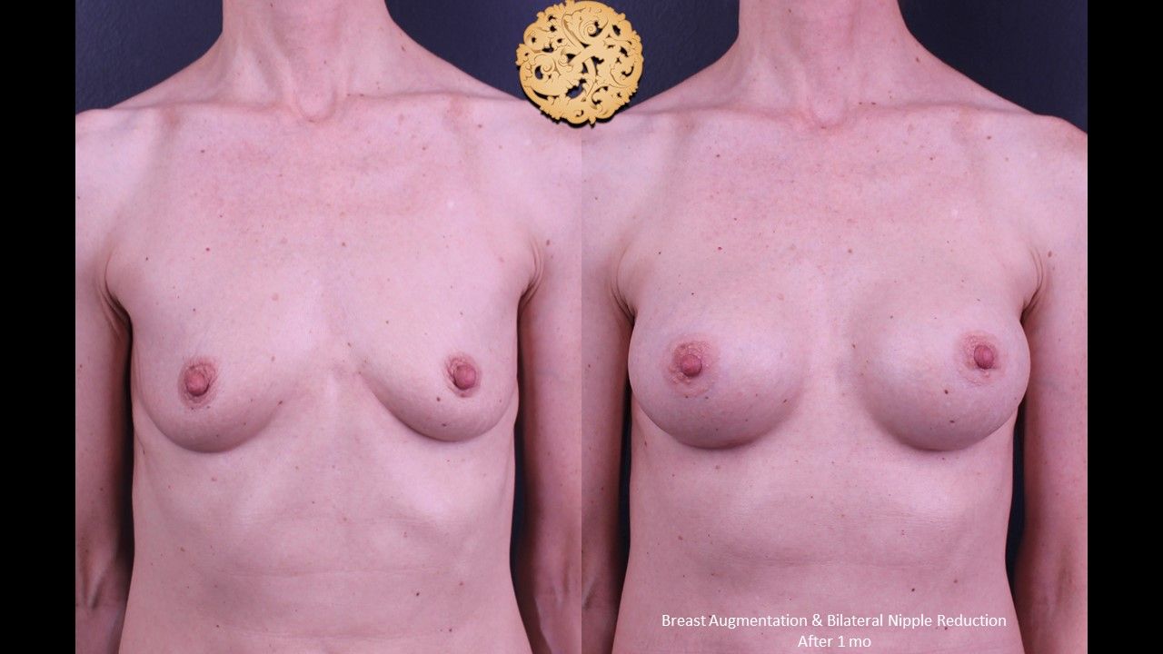 Breast Augmentation Before & After