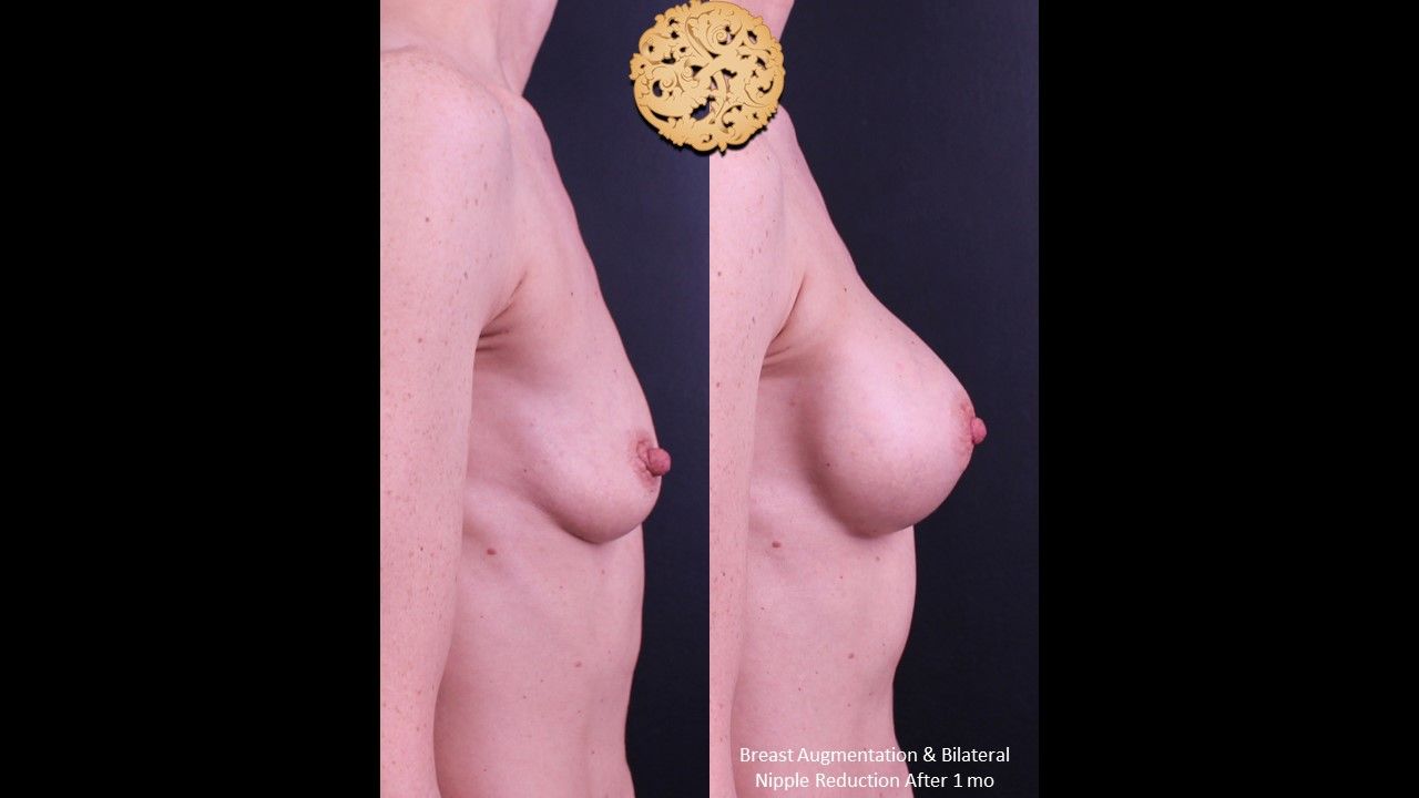 Breast Augmentation Before & After
