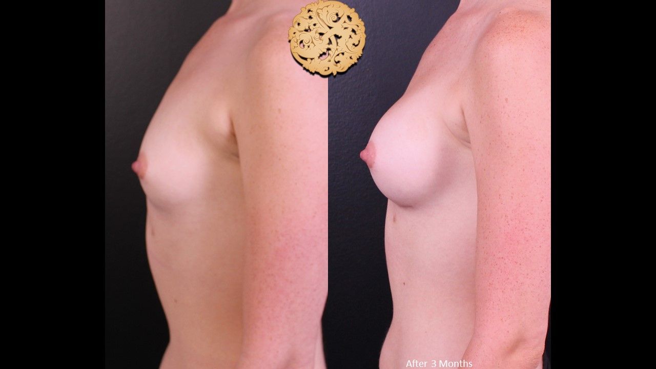 Breast Augmentation Before & After