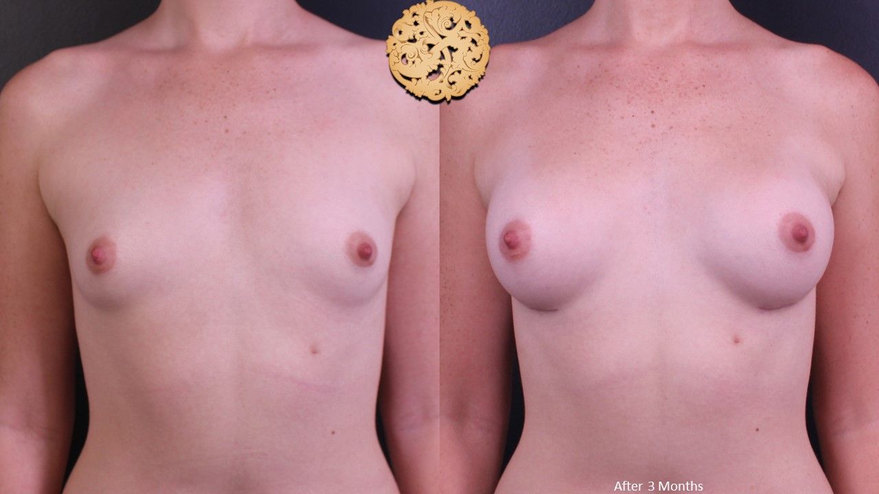 Breast Augmentation Before & After