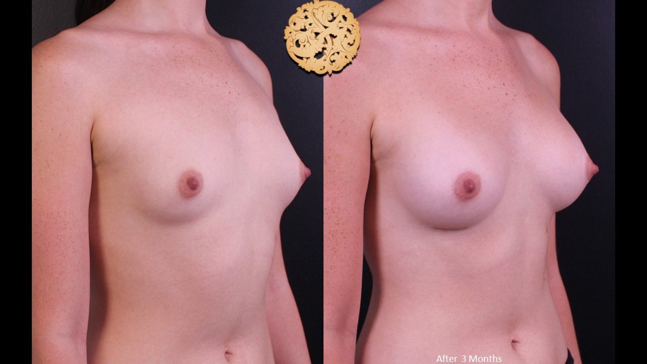 Breast Augmentation Before & After