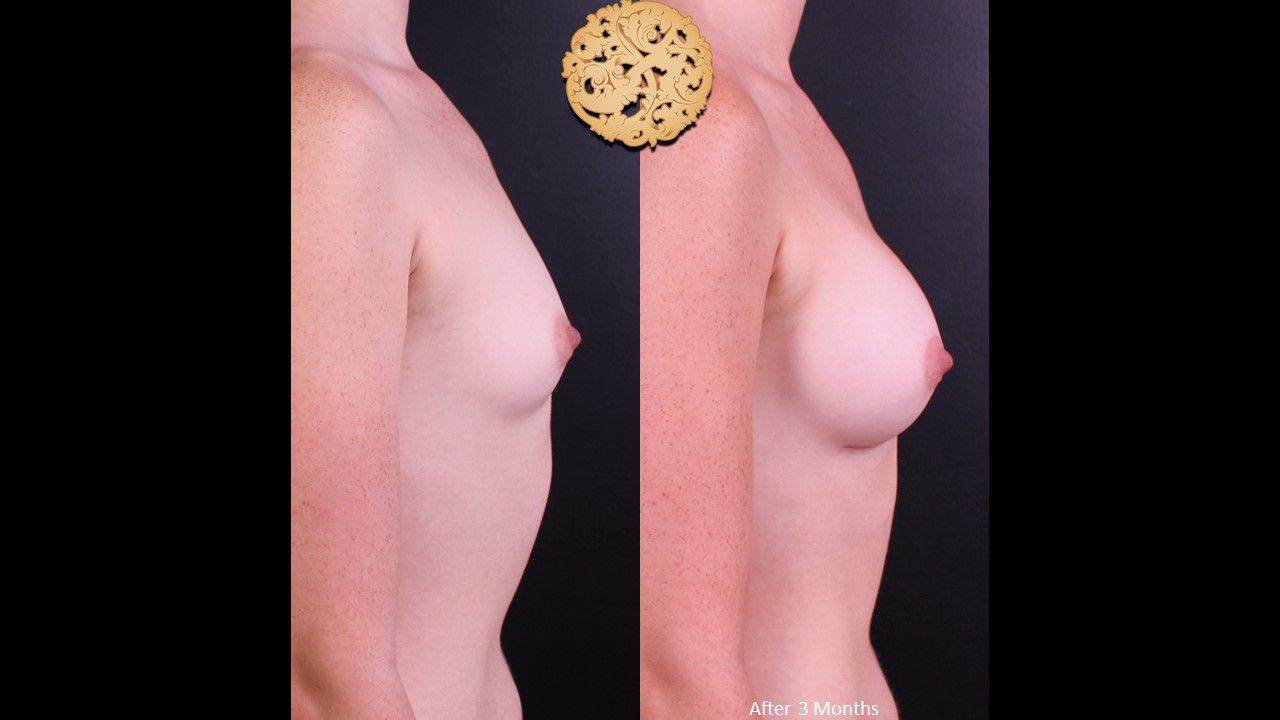Breast Augmentation Before & After