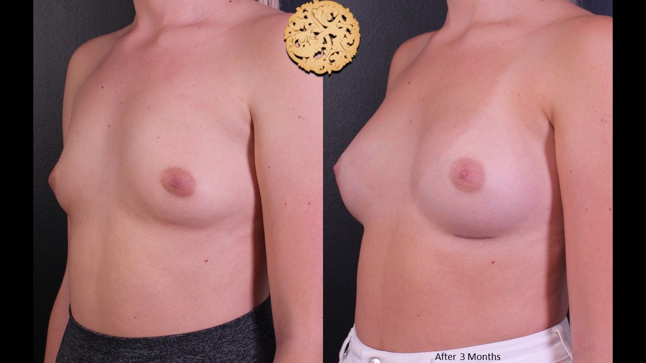 Breast Augmentation Before & After