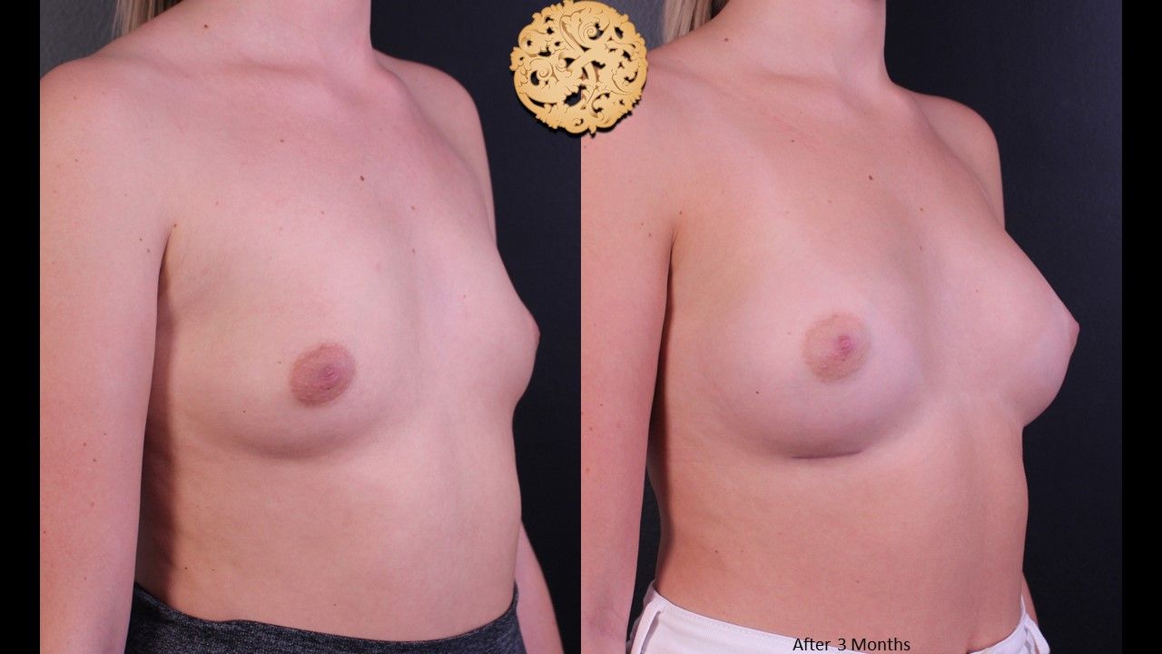 Breast Augmentation Before & After