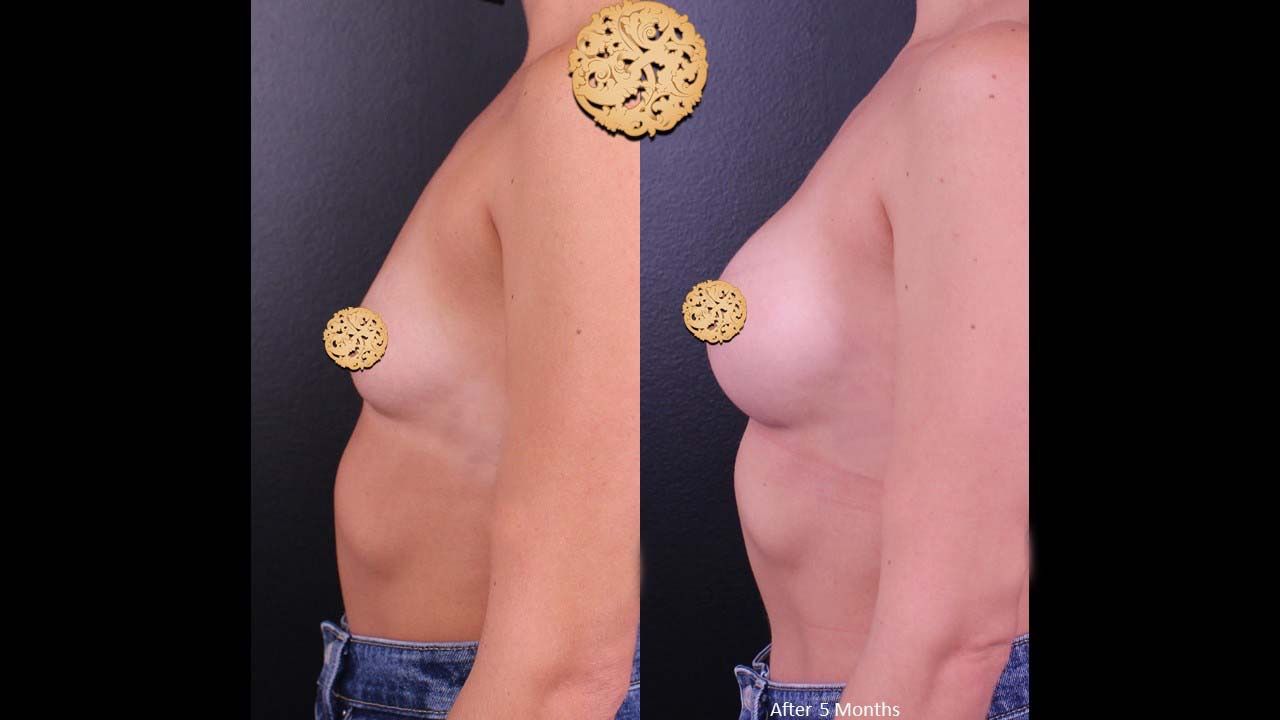 Breast Augmentation Before & After