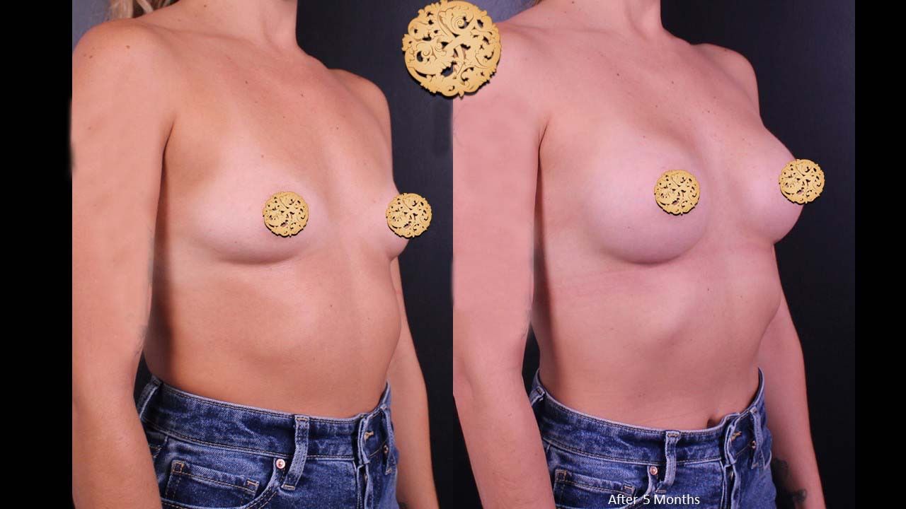 Breast Augmentation Before & After
