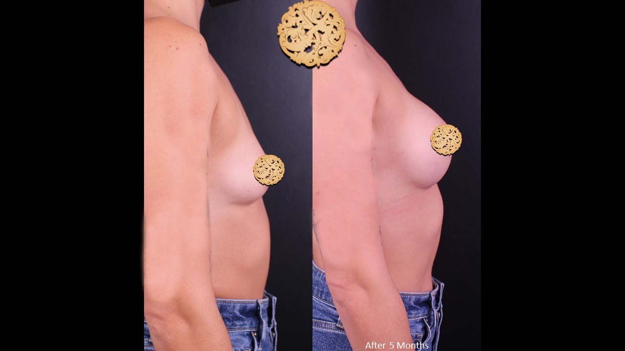 Breast Augmentation Before & After
