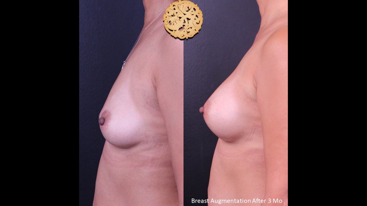 Breast Augmentation Before & After