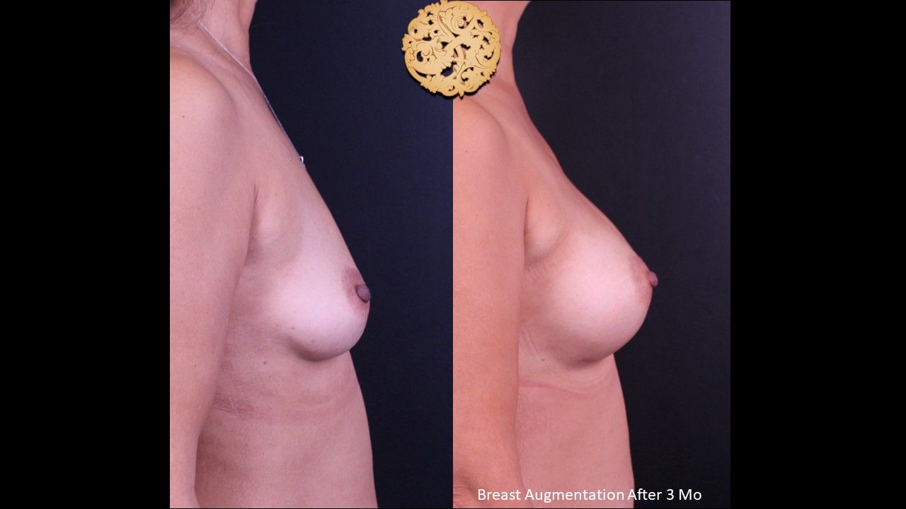 Breast Augmentation Before & After