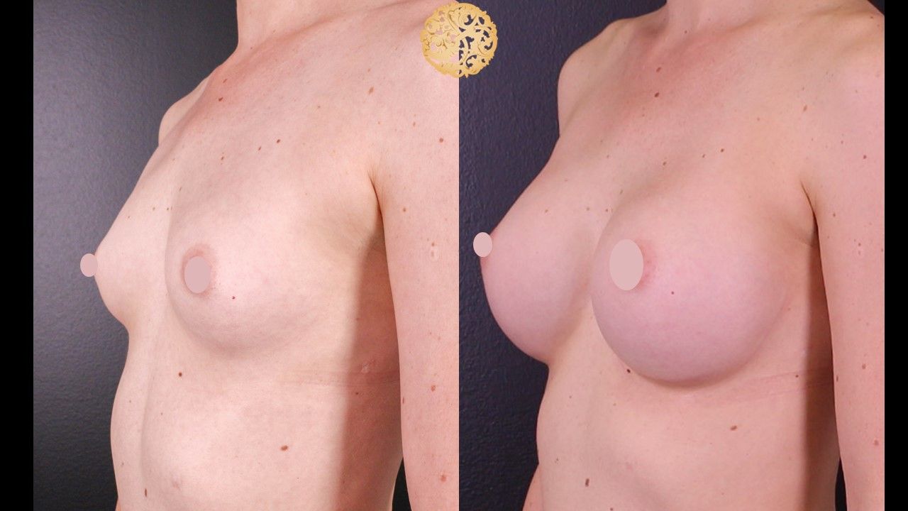 Breast Augmentation Before & After